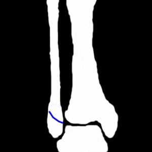 ֐ߊO X-ray photograph