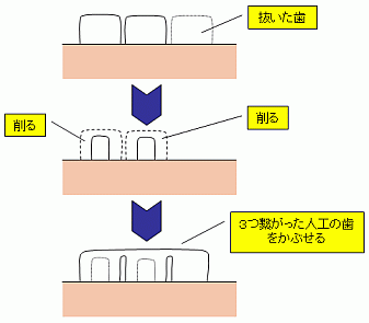 歯の治療のイメージ図